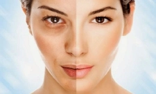 Güneş Lekeleri Belirtileri ve Tedavisi