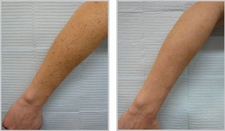 Koldaki Güneş Lekeleri Nasıl Geçer?