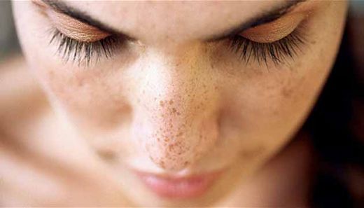 Güneş Lekeleri İçin Maske Tarifleri