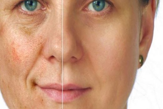 Siyah Güneş Lekeleri Tedavisi